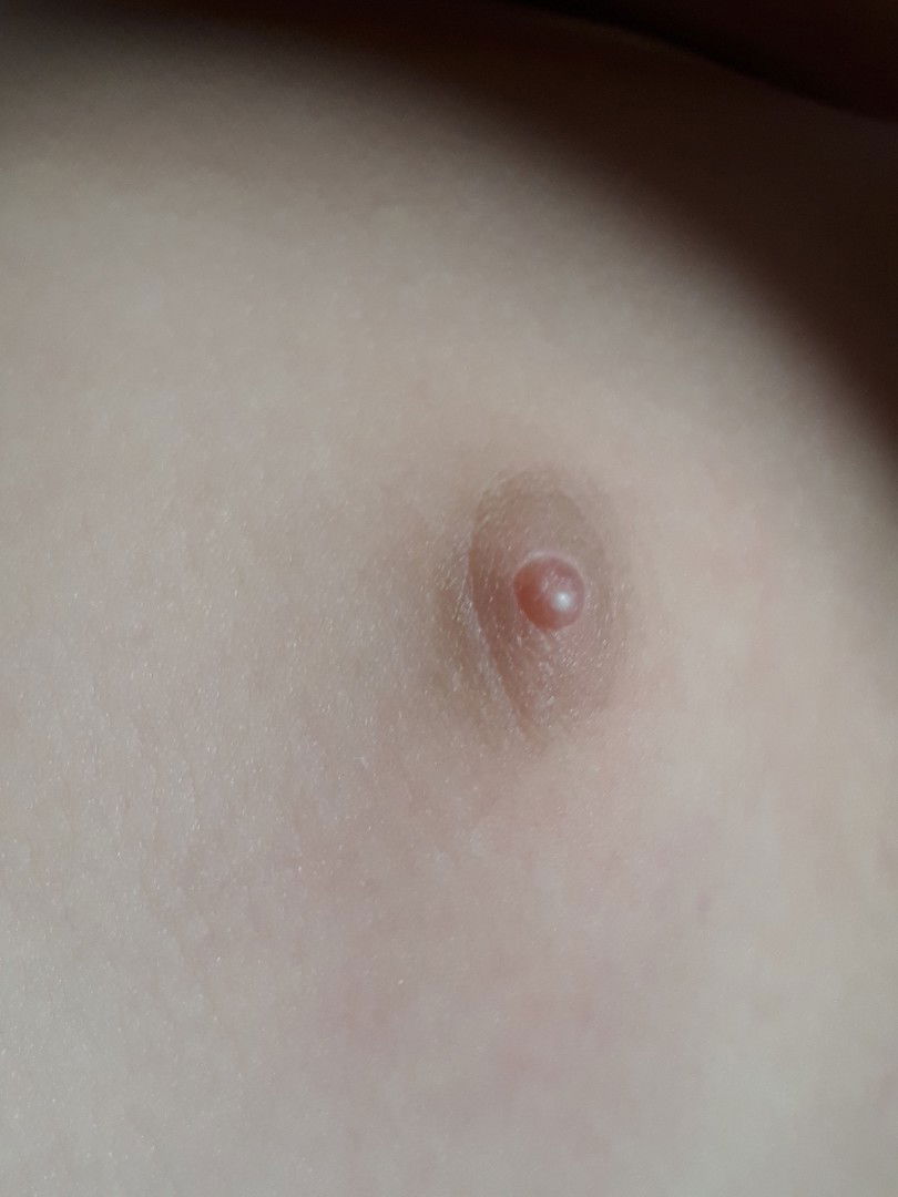 นมน้องเป็นตุ่ม