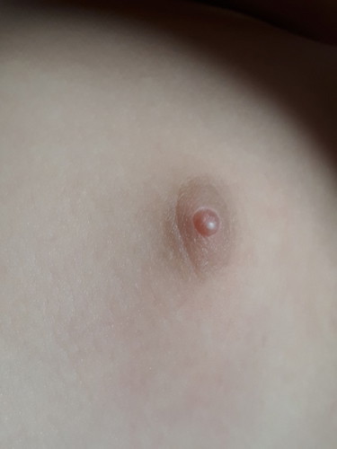 นมน้องเป็นตุ่ม