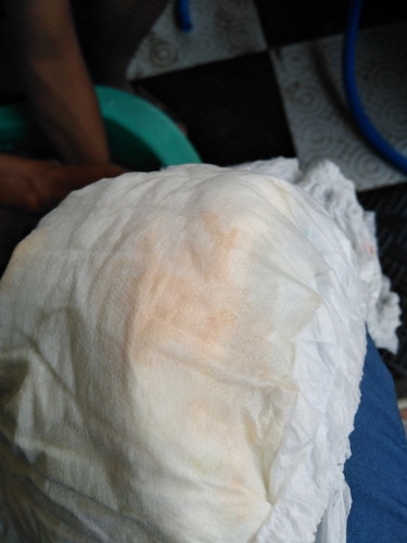 ลูกชาย5เดือนฉี่เหมือนมีเลือดปนออกมาด้วยและฉี่น้อยมาก