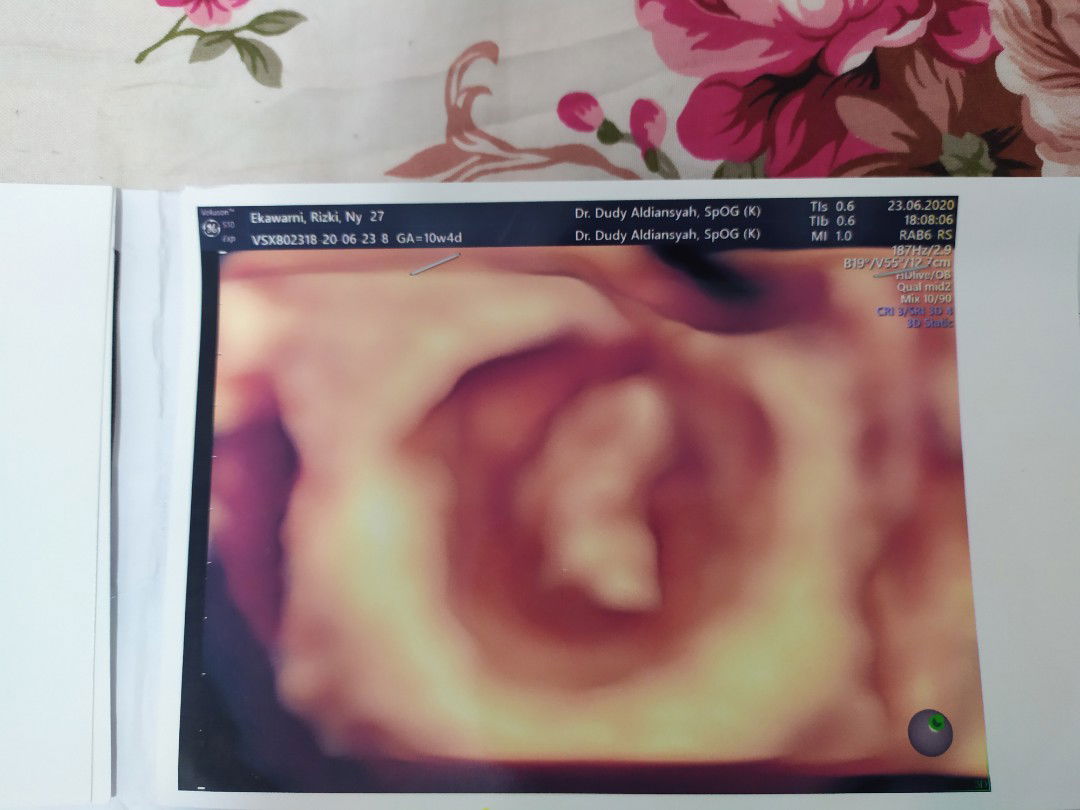 Hamil 9 minggu tapi janin belum ada detak jantungnya