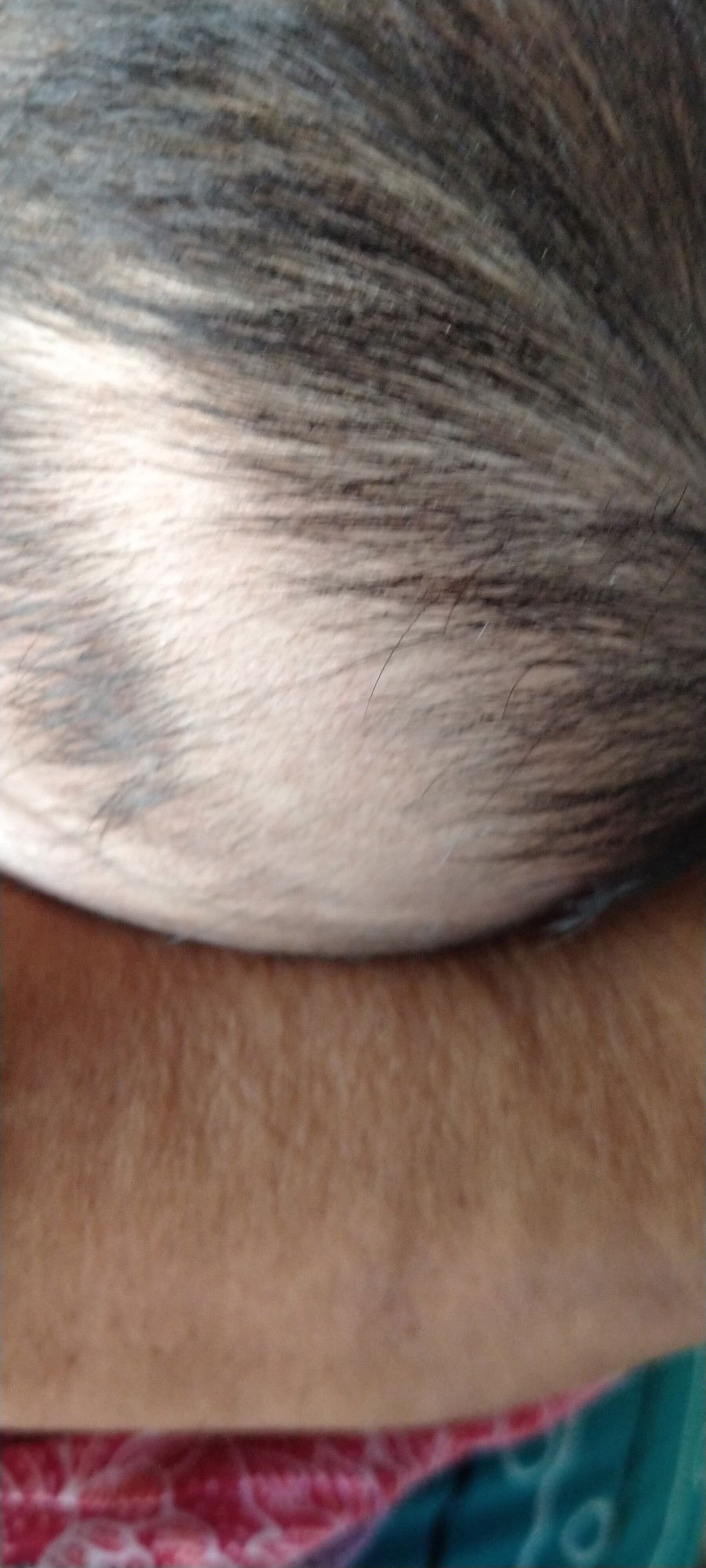 rambut tumbuh tidak rata