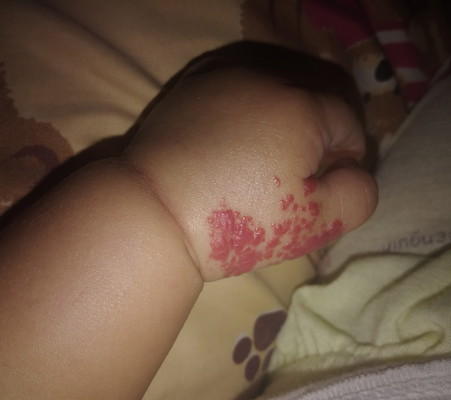 tanda lahir merah