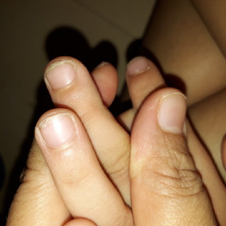 เล็บลูกเป็นแบบนี้เป็นปีปีแล้วค่ะ ทานวิตามินมาสองเดือนแล้วก็ยังไม่ดีขึ้นเลย เป็นเกือบทุกเล้บคะ