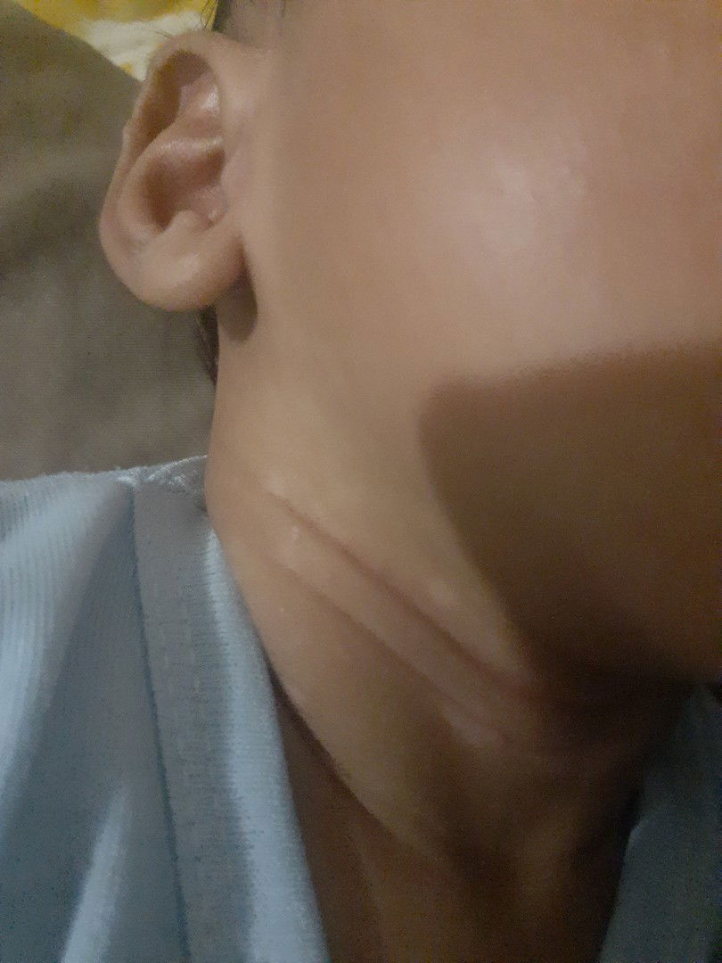 Bercak putih di leher