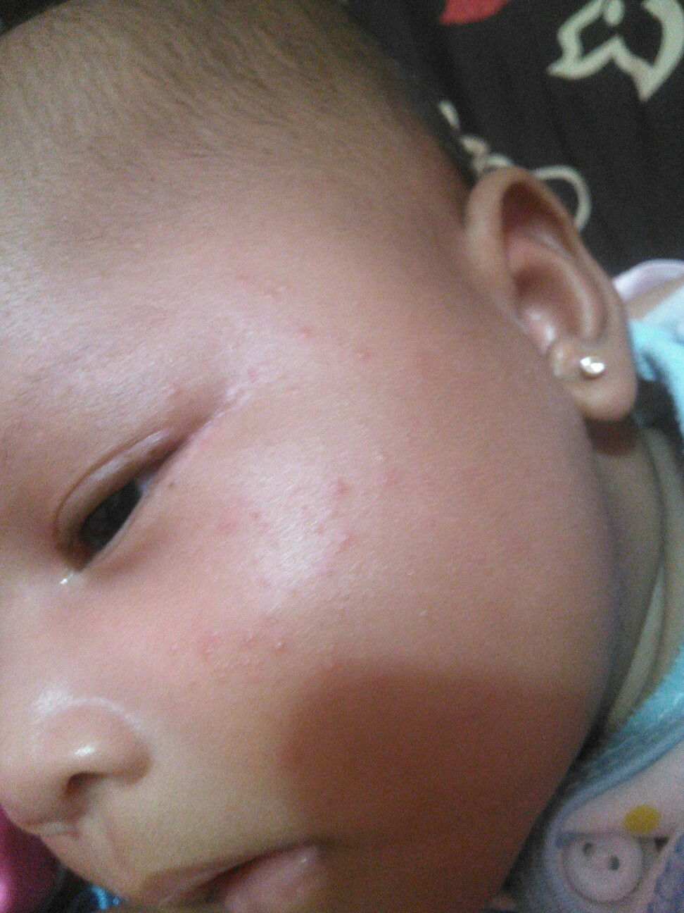 bruntusan di pipi bayi