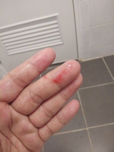 39+5 week โดนกระตุ้นปากมดลูก