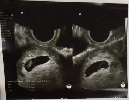 ตั้งครรภ์7w หัวใจไม่เต้น