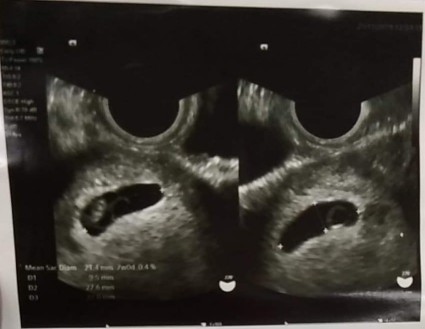 ตั้งครรภ์7w หัวใจไม่เต้น