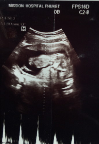 12 week ตอนนี้ 15 week