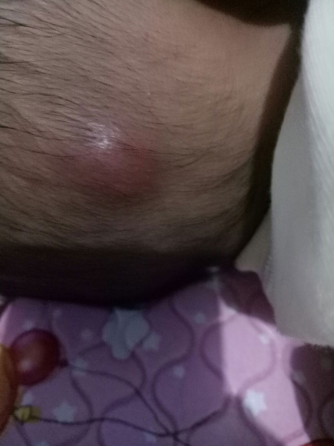 Benjol merah di Kepala