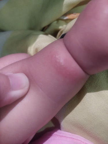 ลูกทีตุ่มขึ้นเป็นอะไรครับ