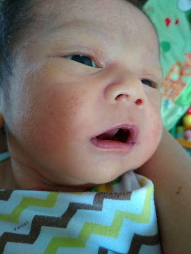 Beruntusan pada bayi?? Jangan langsung panik ya bun