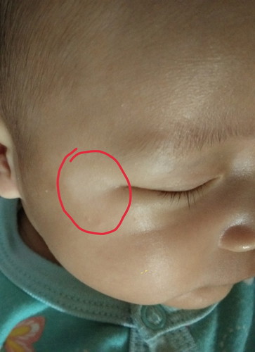 bercak putih diwajah bayi