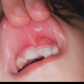 ลูกฟันกระแทกเหงือกปวม