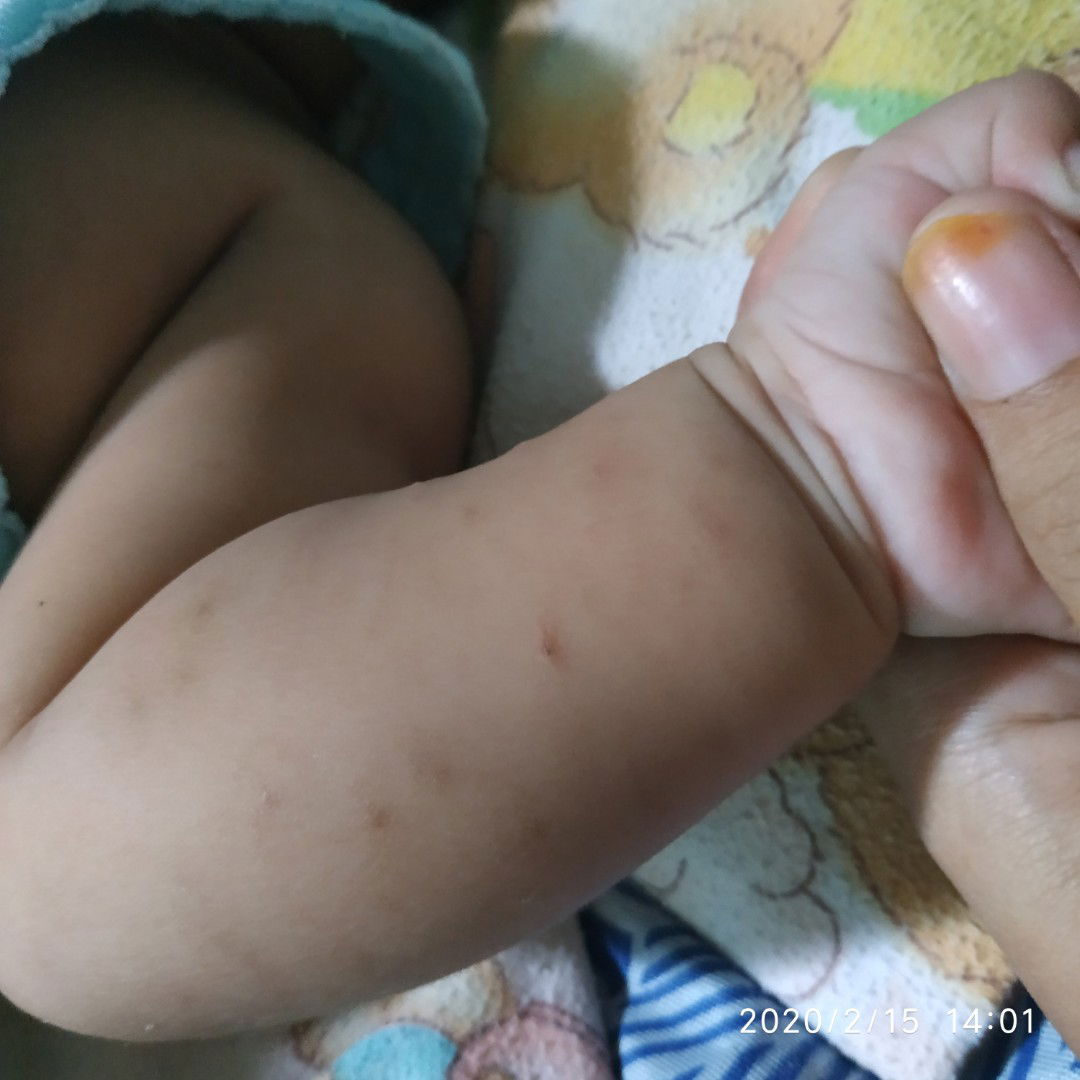 Bekas gigitan nyamuk