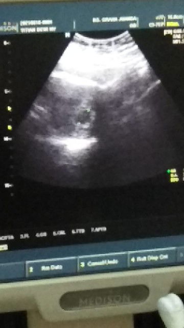 Normalkah ...usg 7 minggu Baru terlihat kantong kehamilan