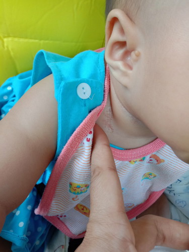 ลูกมีผื่นที่คอค่ะ