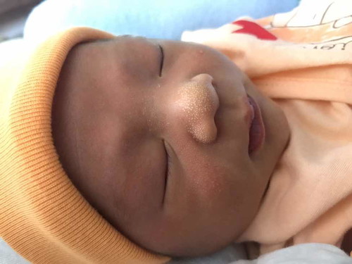 ผดผื่น ไขมัน