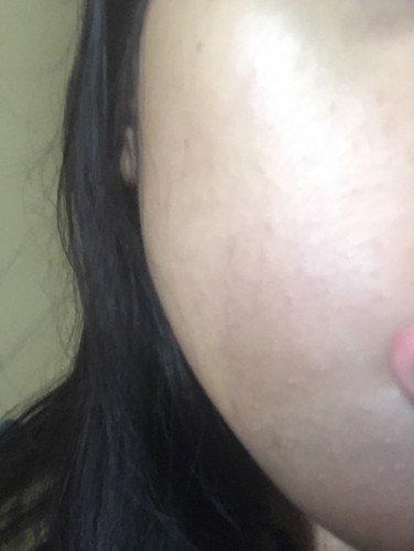 Muka bruntusan pascamelahirkan