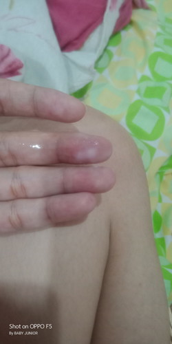 แบบนี้คือตกขาวใช่ไหม