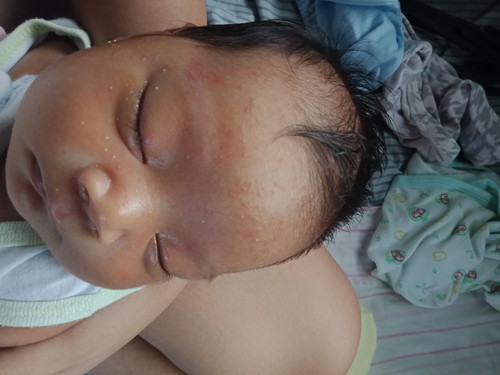 rashes