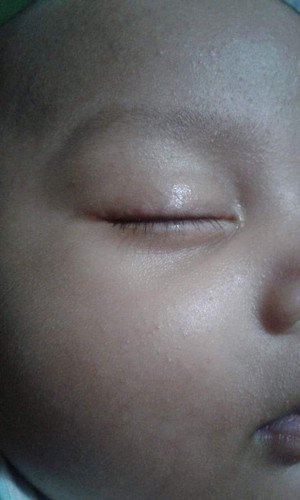 allergy