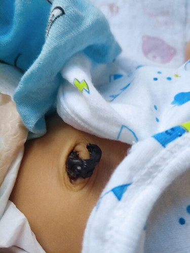 ปกติสะดือน้องกี่วันหลุดคะ