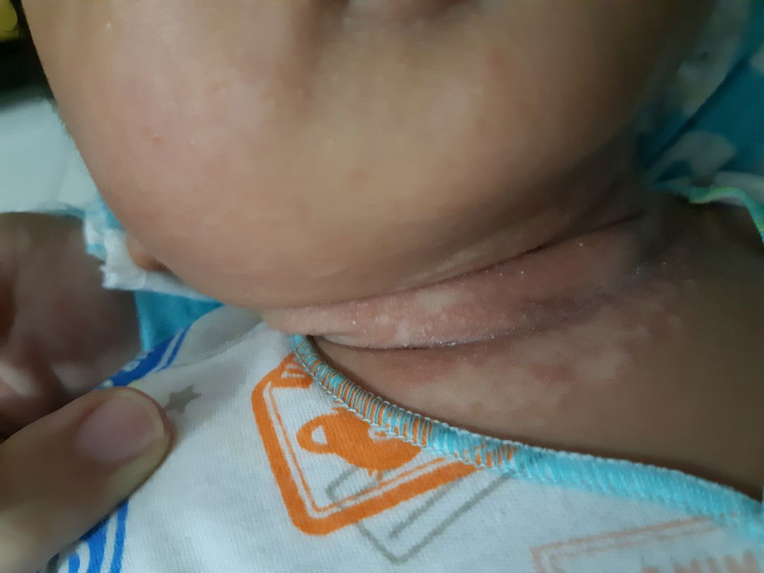 bercak putih d biang keringat pada bayi 1 bulan 3 hari