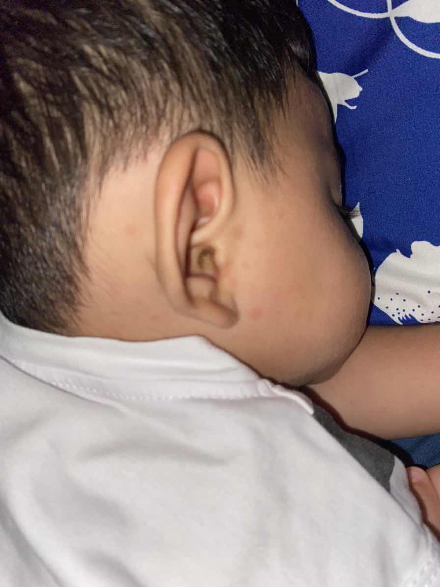 น้อง9เดือน มีผื่นขึ้นแบบนี้ เกิดจากอะไร