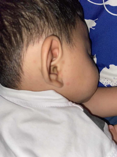 น้อง9เดือน มีผื่นขึ้นแบบนี้ เกิดจากอะไร