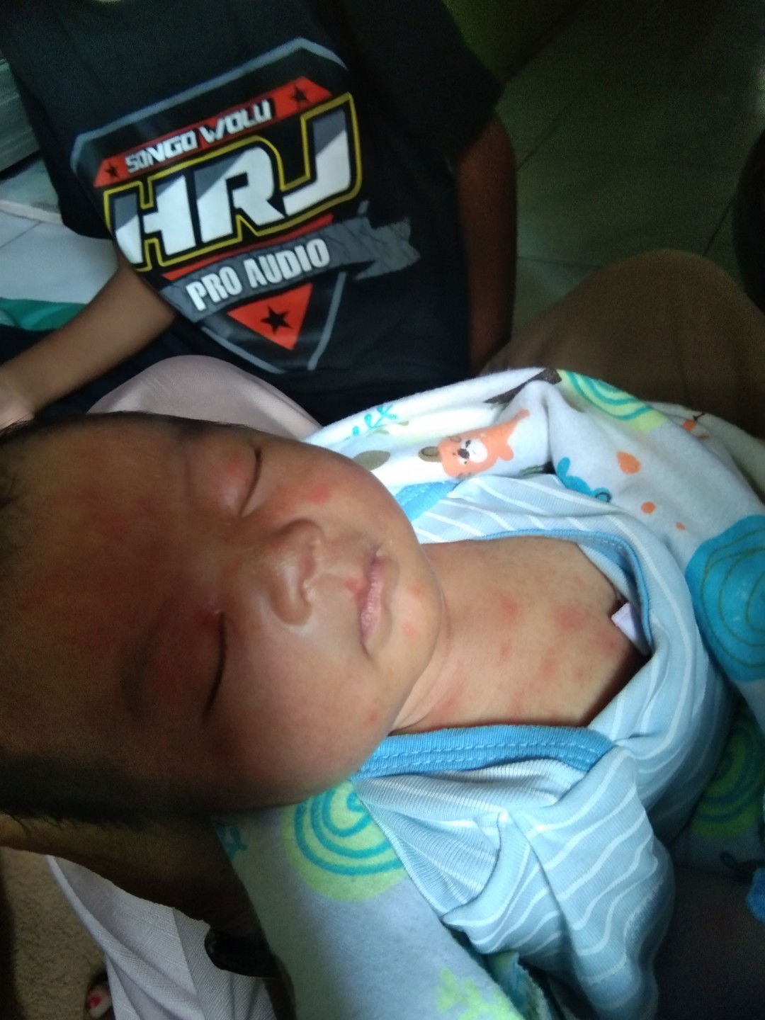 Ruam merah pada pipi bayi