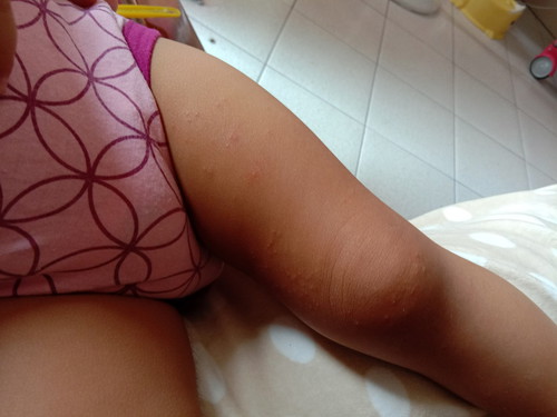 rashes?