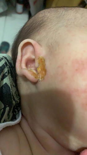 Skin Allergy
