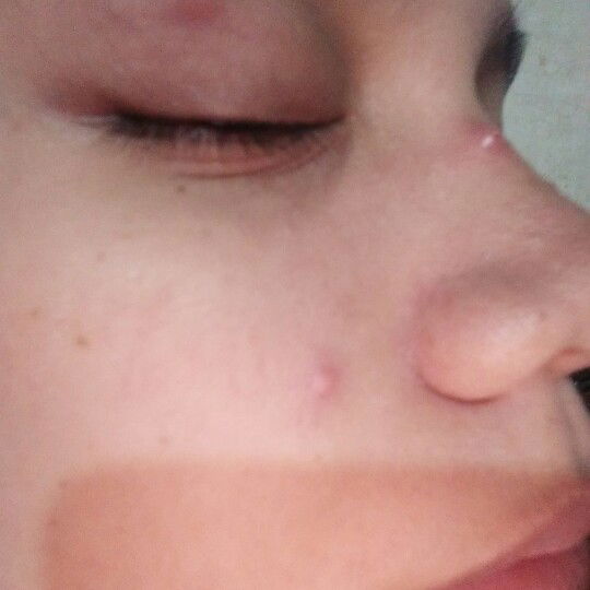 pigsa problem during pregnancy