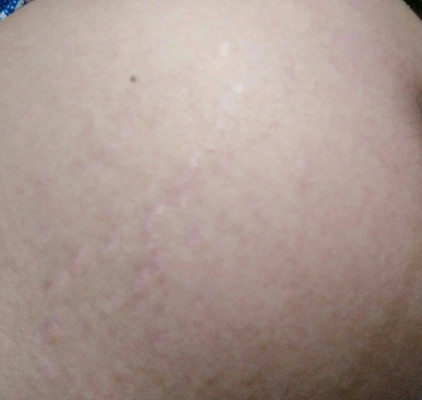 Stretchmark