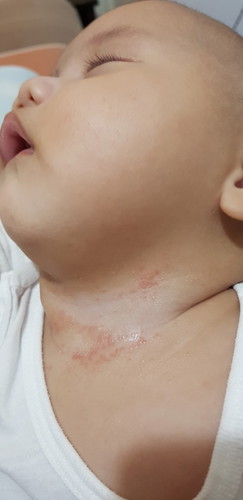 skin rashes
