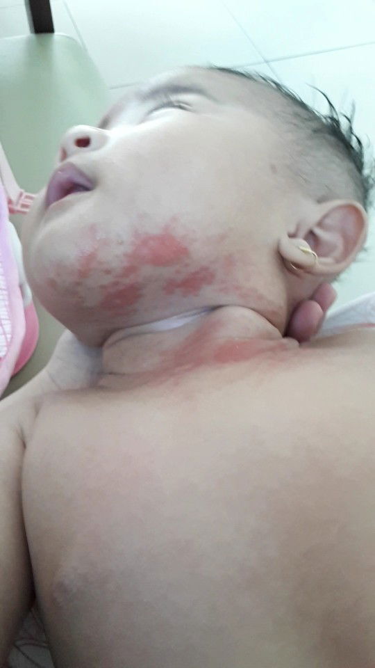 ruam di leher bayi