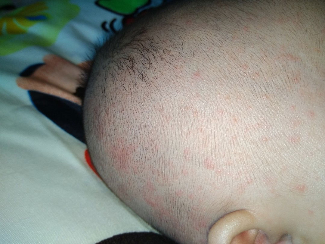 Bintik Merah Dikepala Aja