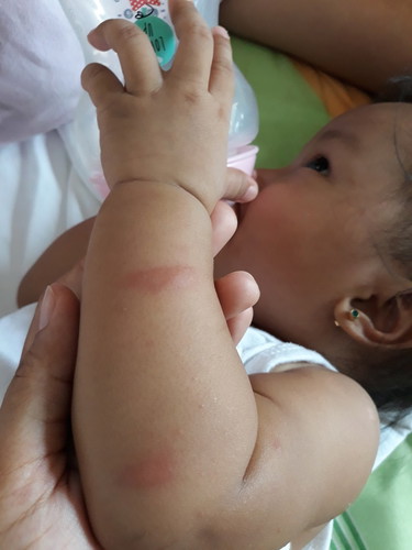 ant bite/mosquito bite