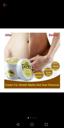 Effective Stretchmark Remover?