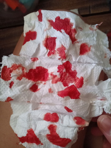Nosebleed