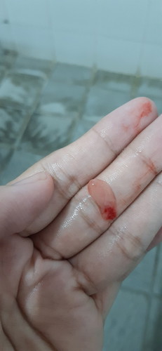 ketulan di lubang vagina