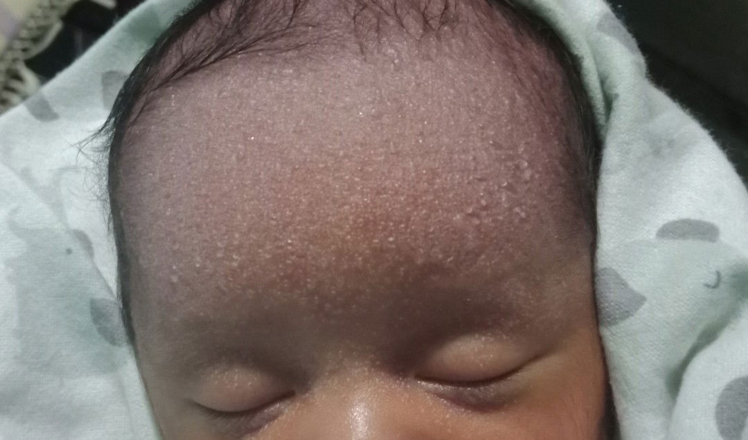 gelembung berair pada bayi