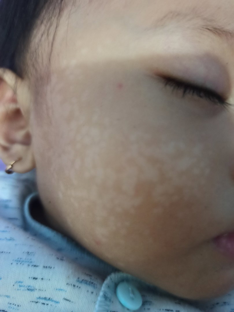 bercak putih di pipi bayi