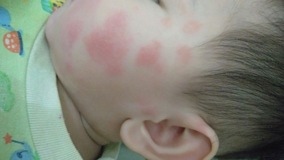 Merah2 pada pipi, kaki dan badan bayi..