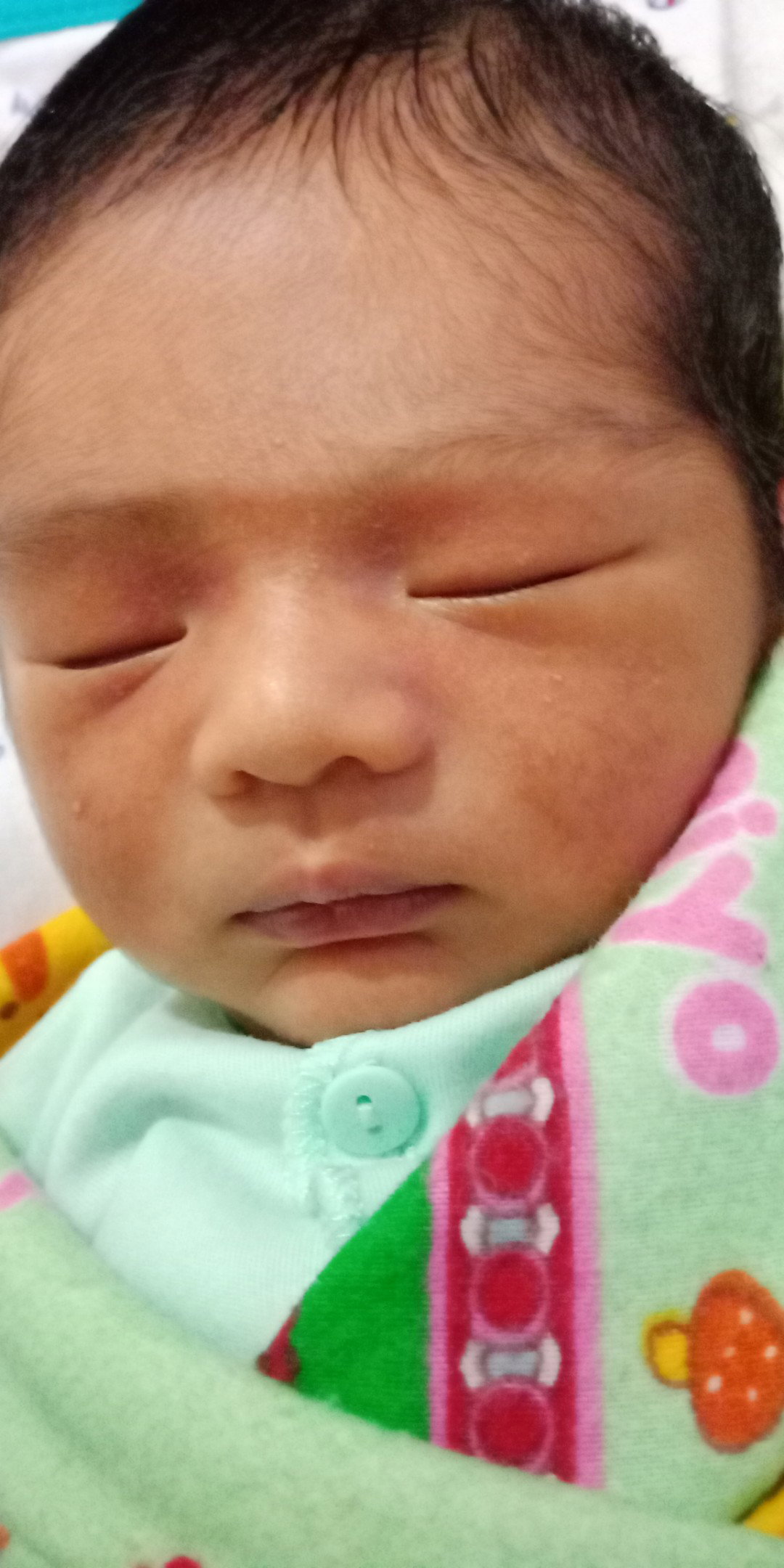beruntusan pada wajah bayi