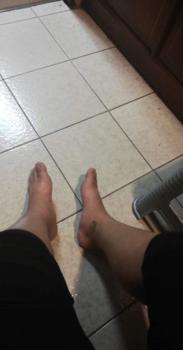 ขาบวมมือบวม