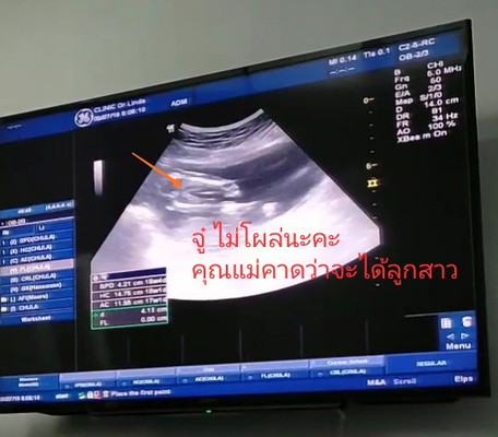 18+1w คุณหมอบอกจู๋ไม่โผล่ คาดว่าจะได้ลูกสาวกี่%ค่ะ