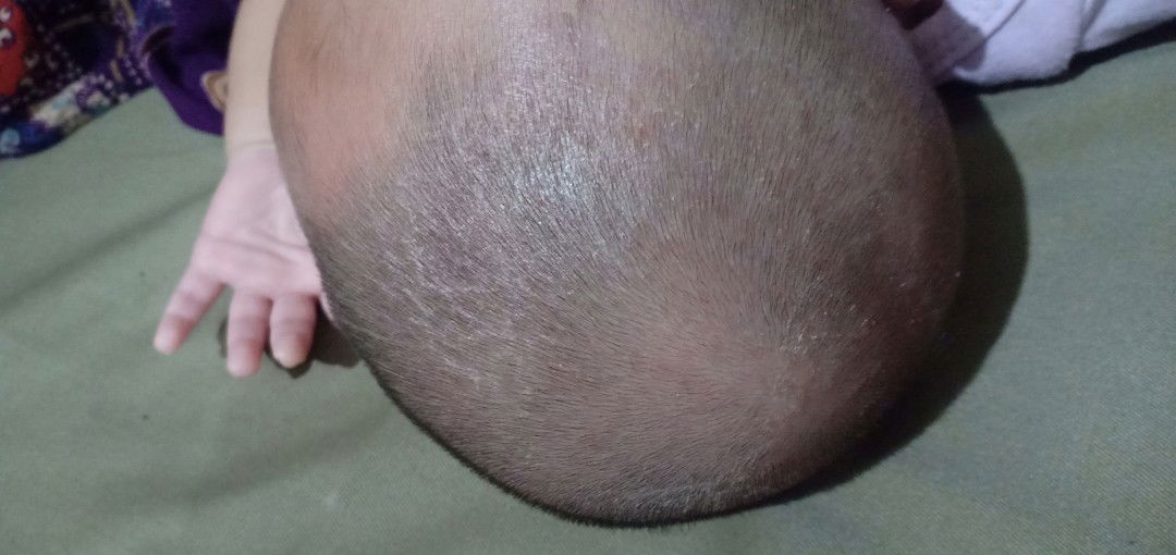 kulit kepala bayi berkerak