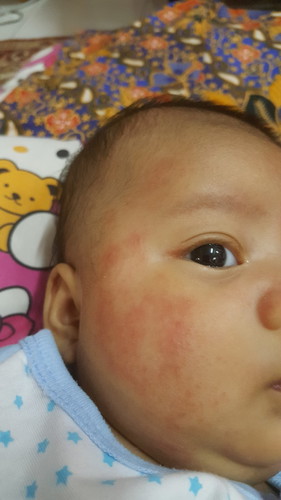 ruam baby
